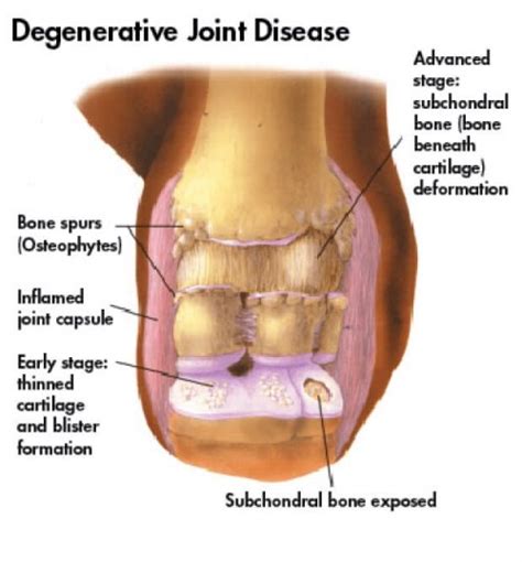 Degenerative Joint Disease Causes And Treatment Step To Health