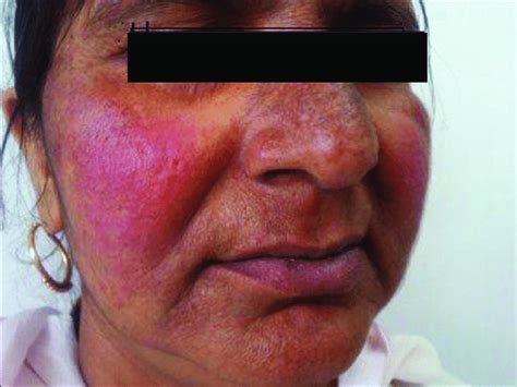 Prolonged Use Of Topical Steroids For Melasma Causing Persistent Facial