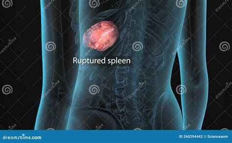 A Ruptured Spleen Is A Medical Emergency That Occurs As A Result Of A