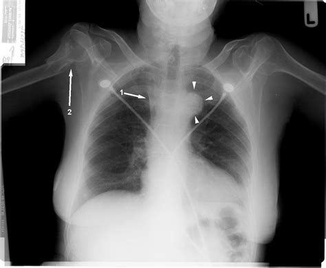 Can A Chest X Ray Detect Dilated Aorta Steve Gallik