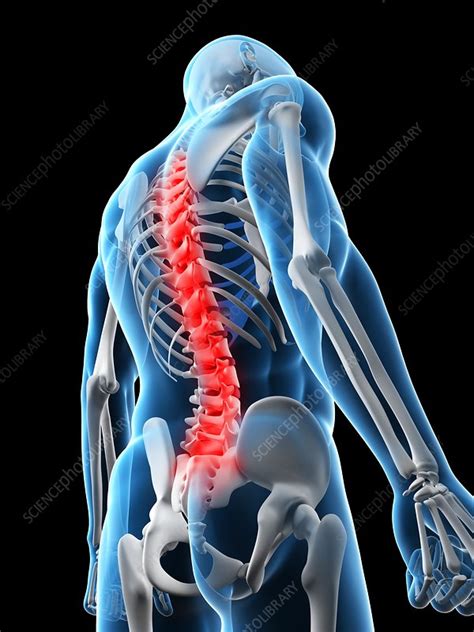 Back Pain Conceptual Artwork Stock Image F0041217 Science Photo