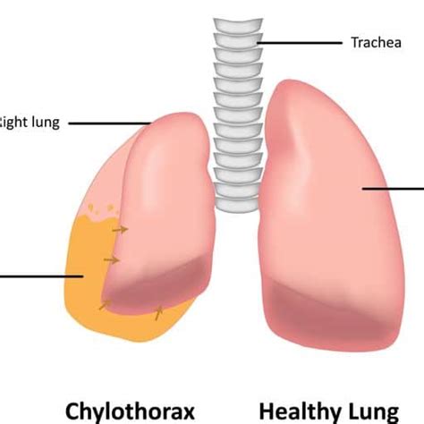 A Guide To Understanding And Treating Chylothorax In Singapore Icts