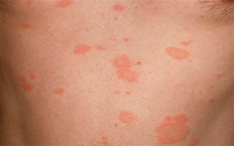 Pityriasis Rosea On Face