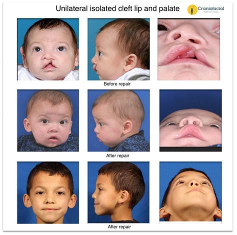 Unilateral Isolated Cleft Lip Dell Childrens Craniofacial Team Of Texas