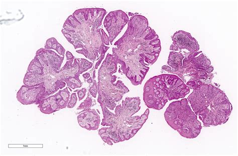 Pathology Outlines Squamous Papilloma Conjunctiva