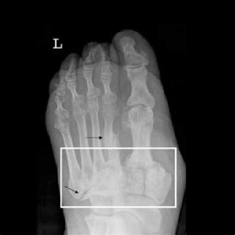 Signs Of Early Stage Neuro Osteo Arthropathy Charcot Foot On