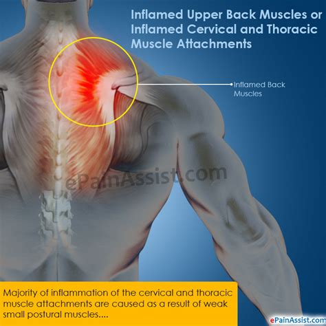 Seven Common Misconceptions About Cure Muscle Spasms Upper Back Cure