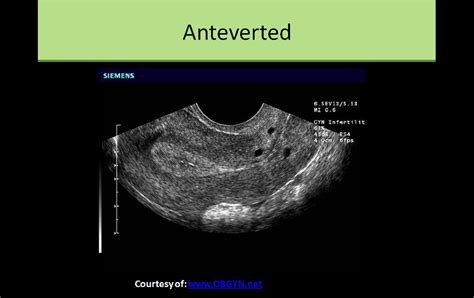 Anteverted Uterus On Ultrasound Ultrasound Diagnostic Medical