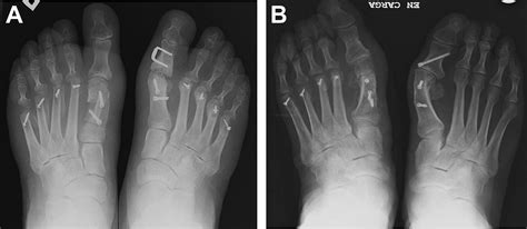 Management Of Complications After Hallux Valgus Reconstruction Foot