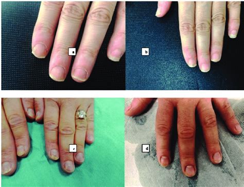 The Pre Treatment A And Post Treatment B Photographs Of Three Nails Download Scientific