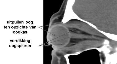 Oogziekte Van Graves Oorzaak Symptomen Behandeling Simptonl