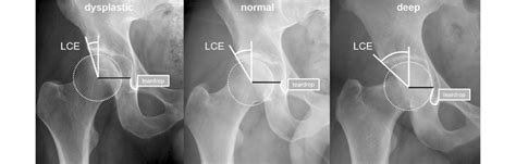 Anteroposterior Radiographs Of Different Right Hip Joints The Lateral
