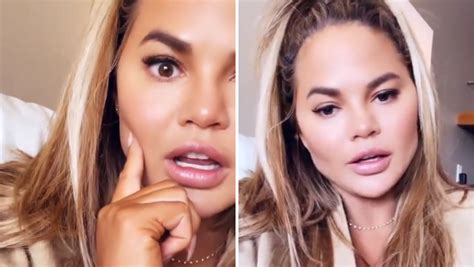 Chrissy Teigen Tells How She Had Cheek Reduction Surgery So What Is