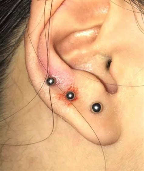 Infected Tragus Piercings Symptoms And Treatment Churinga Ear Piercings Churinga
