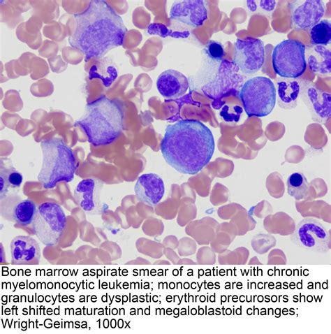 Pathology Outlines Chronic Myelomonocytic Leukemia