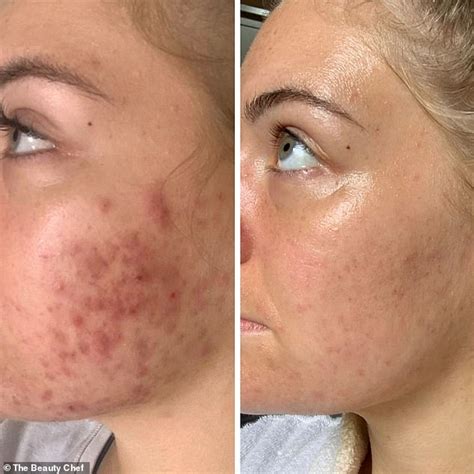 Young Woman Who Struggled With Severe Cystic Acne For Years Reveals How