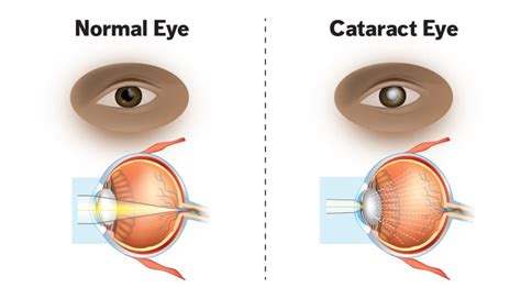 What are the precautions to be taken after lasik eye surgery? How Old Do You Have To Be To Get Laser Eye Surgery? - iCharts