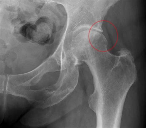 Femoro Acetabular Impingement Hip Disorder Explanation Back Pain My