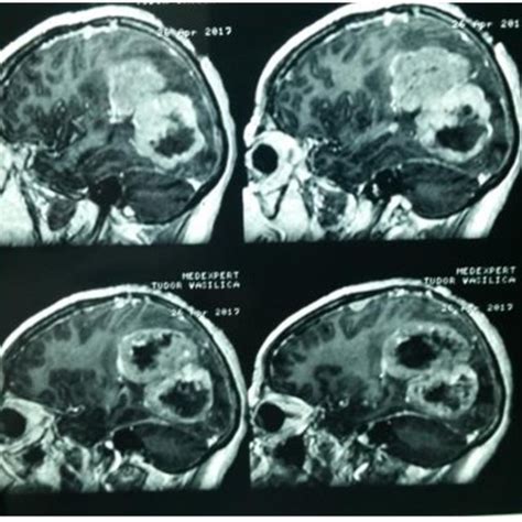 Preoperative Enhanced Ct Scan Images Sagittal View Download