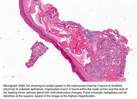 Mucous Retention Cyst Lip Histology