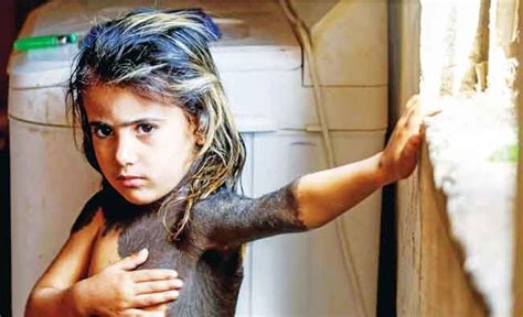 In An Iraqi Village A Little Girl Hides Skin Disease From Neighbors