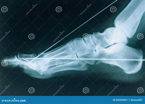 X Ray Of The Foot Fracture Of The Bones Of The Foot Stock Image