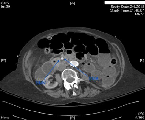 Axial Ct Scan Of Abdomen With Iv Contrast Smv Was Located To The Right