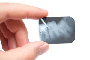Areas of decay not visible in an oral exam. Dental X-ray FAQs | North Bay Dental | San Rafael, CA Dentist