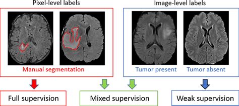 Deep Learning With Mixed Supervision For Brain Tumor Segmentation