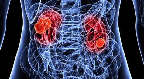 Acute Kidney Injury Pearls And Pitfalls Emdocs