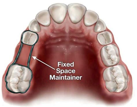 Removable Orthodontic Appliance