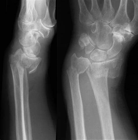 Smith Fracture • Litfl • Medical Eponym Library