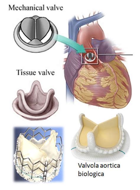 Cardiac Valvular Prosthesis