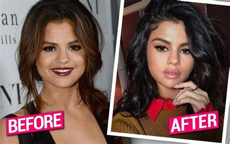 Selena Gomezs Luscious New Lips Exposed By Top Plastic Surgeons