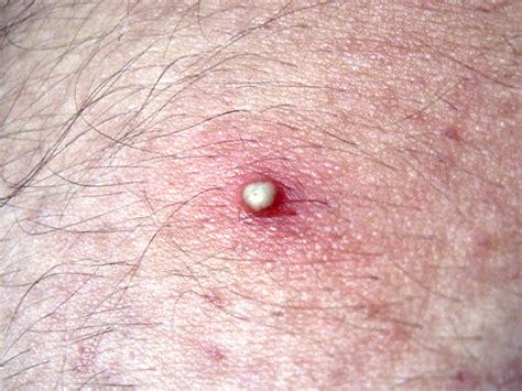 How Long Does Folliculitis Last Tips To Speed Up Your Recovery