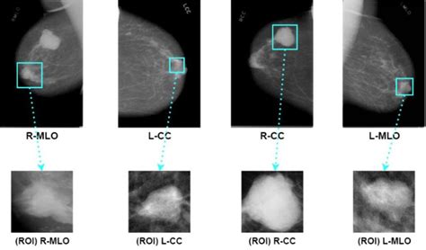 Mammograms And Extracted Patches Of Different Views Right Mlo Left