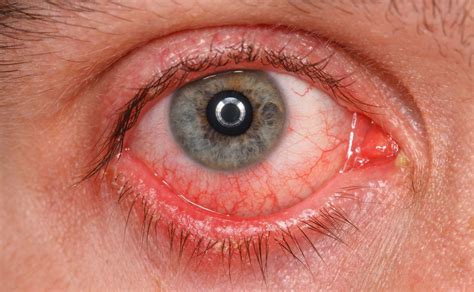 ¿qué es el síndrome del ojo seco y cuáles son sus causas la raza