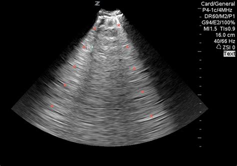 Pulmonary Edema Ultrasound