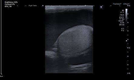 Hematocele Postoperative Testicular Ultrasound Radiology Case