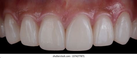 Healthy Gums Over 42221 Royalty Free Licensable Stock Photos