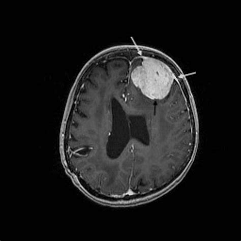 Cureus Glioblastoma Multiforme Survivor With Radiation Induced