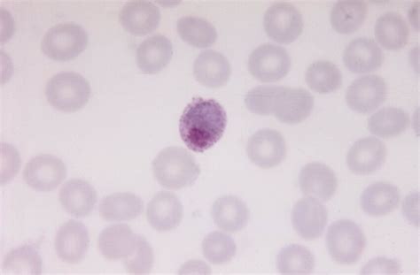 Kostenlose Bild D Nn Film Mikrobild Zeigt Reif Trophozoite Parasiten Plasmodium Ovale
