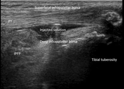 Ultrasonographic Finding Long Axis Image Deep Infrapatellar Bursa
