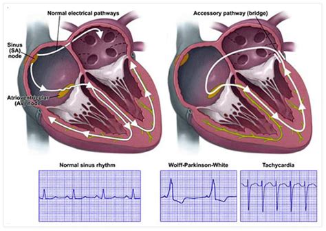 What Is Supraventricular Tachycardia Svt Svt Heart Cardiac Images And Hot Sex Picture