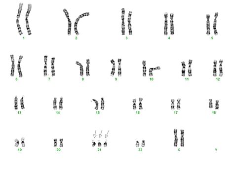 Die robertson'sche translokation 15;21 sowie das ringchromosom 21 sind sehr seltene chromosomale aberrationen, die zu einem deutlich erhöhten risiko für die entwicklung einer all. Chromosomenanalysen - allgemeine Informationen | DNA ...
