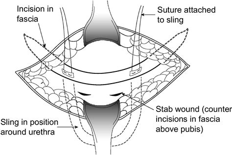 Pubovaginal Fascial Sling For The Treatment Of All Types Of Stress