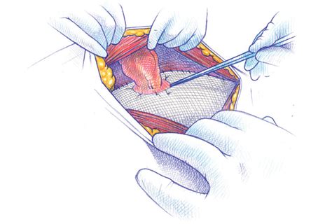 Hernia Del Estoma O Hernia Paraestomal Valencia Quirúrgica Hernia