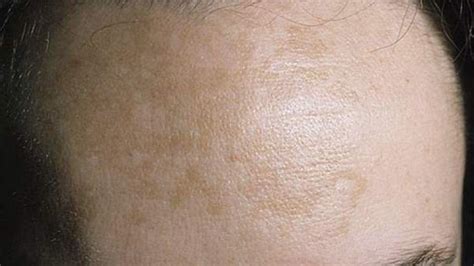 Manchas En La Cara Por Estres Que Es La Dermatitis Perioral Sintomas
