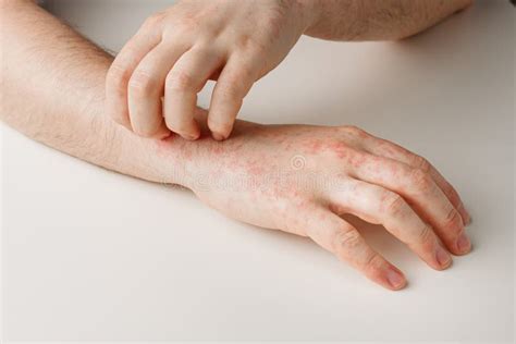 Hands With Allergy Reaction From Taking Medicines By Effect