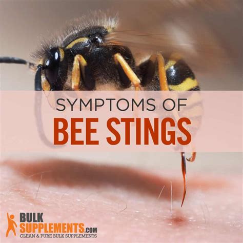Bee Stings Characteristics Causes And Treatment
